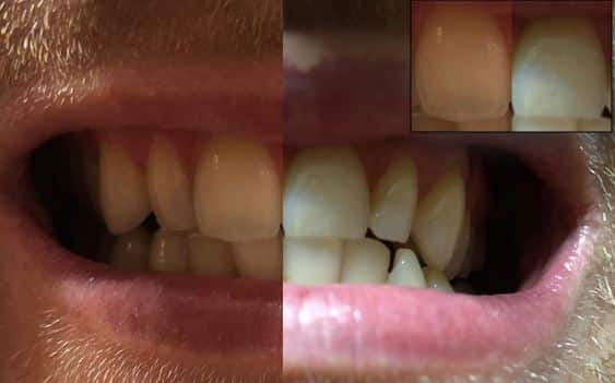 Zahnaufhellung Aktivkohle vorher-nacher-Bild